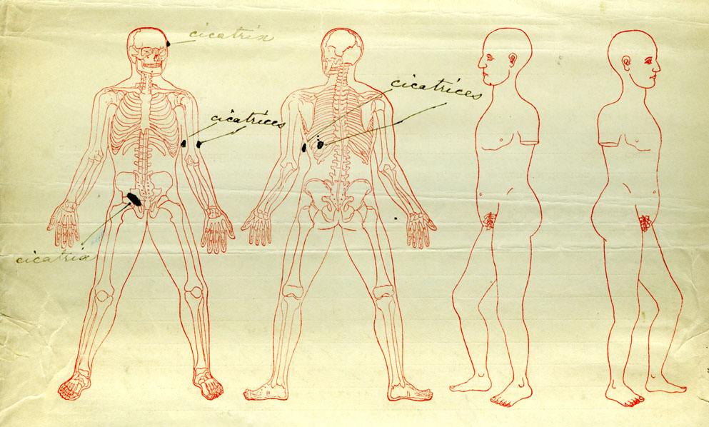 anatomical drawing to show Edson Bemis's injuries